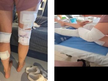 Ολλανδή τραυματίστηκε σοβαρά μετά από επίθεση αδέσποτων σκύλων 